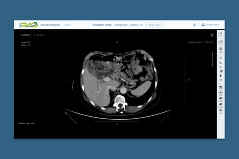AI-based Lesion Detection project