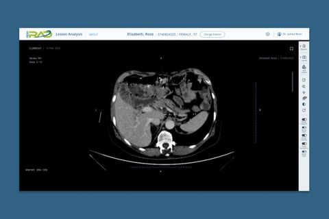 AI-based Lesion Detection project