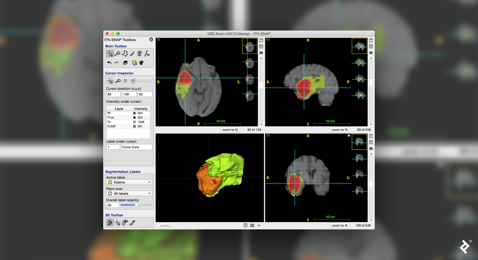 The ITK-SNAP user interface after completed brain tumor segmentation. Three orthogonal slices through the scan are shown.